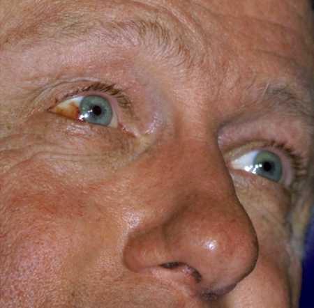 Clinton needs some Visine after not inhaling that Jamaican Ganja